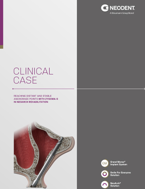 Neodent® ZYGOMA S – Clinical case 3