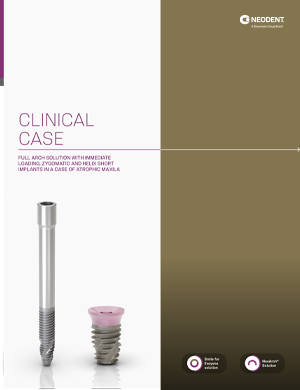 Neodent® ZYGOMA S – Clinical case 4