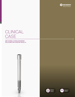 Neodent® ZYGOMA S – Clinical case 5